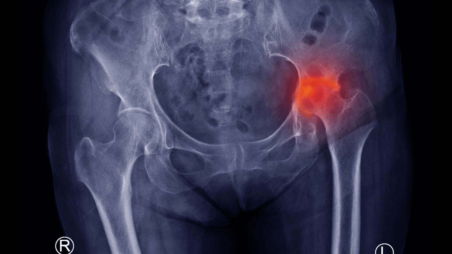 nécrose avasculaire