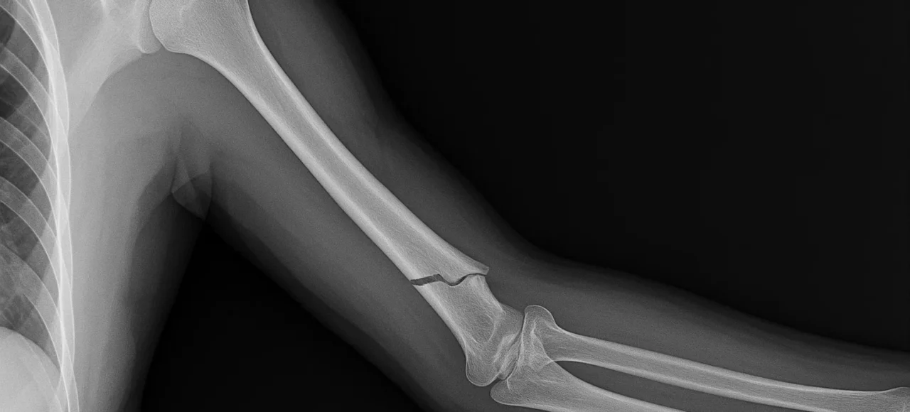 fracture de humerus